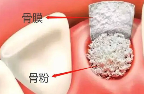 缺牙必看：种植牙必须用骨粉吗？种植牙怎么判断要不要植骨粉